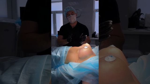 Якорная подтяжка с одномоментным протезированием имплантатами