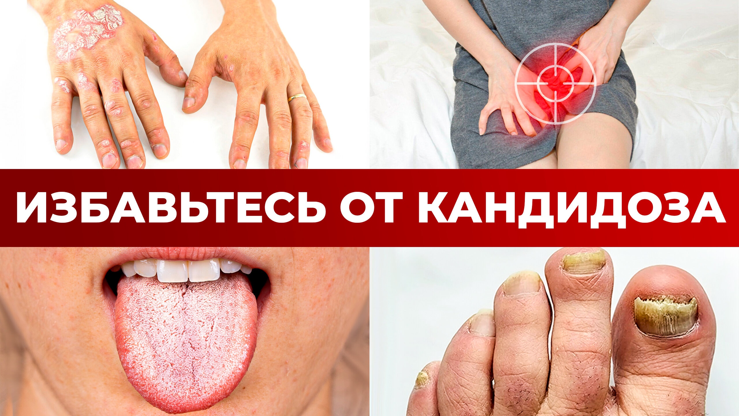 Как вылечить КАНДИДОЗ без ТАБЛЕТОК? / Первопричина кандидоза
