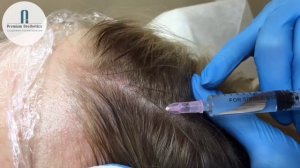 МЕЗОТЕРАПИЯ КОЖИ ГОЛОВЫ С КОРОТКИХ КСЕНИЕЙ. 16.04.2019.