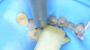 Реставрация режущих краев нижних резцов (прямой эфир)