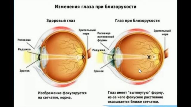 Как лечить близорукость Эндорфинотерапия смотреть онлайн