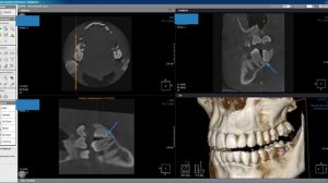 КТ челюсти, ретинированные восьмерки, зуб мудрости