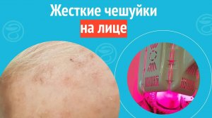 🧑🦲 Жесткие чешуйки на лице. Клинический случай №1251