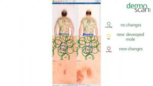 Dermoscan X2 - Картографирование всего тела за 60 секунд