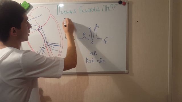 ПОЛНАЯ И НЕПОЛНАЯ БЛОКАДА ПРАВОЙ НОЖКИ ПУЧКА ГИСА! смотреть онлайн