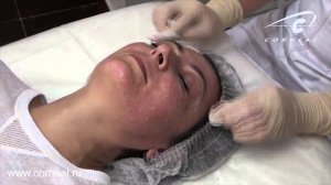 Почему важно знать в какой слой колется биоревитализация?