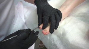 Вросший ноготь. Поэтапная процедура удаления ногтя и рекомендации.