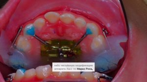 неправильный прикус