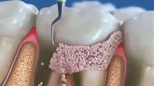 Механический способ удаления зубного камня, 3D видео