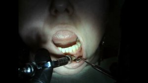 Инфильтрационная анестезия для лечения 33 зуба.