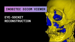 Реконструкция глазницы с помощью Inobitec DICOM Viewer Pro