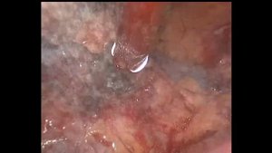 Киста перикарда - торакоскопия удаление.