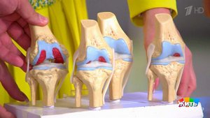 Остеоартроз: боль в коленных суставах. Жить здорово! Фрагмент выпуска от 18.12.2017