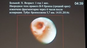 20 Бронхоскопия при инородных телах трахеобронхиальной системы у детей Писанка В В