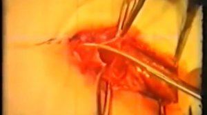 Герниотомия и герниопластика паховых грыж