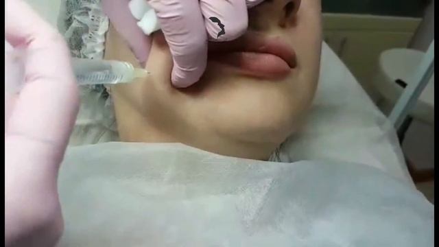 Коррекция овала лица.