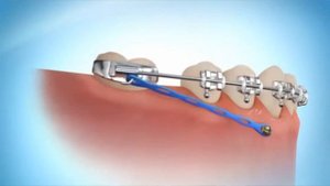 Удалять ли зубы мудрости или четверки для брекетов?