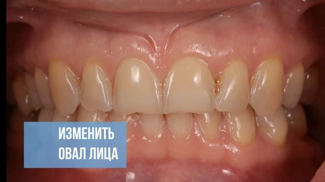 Подтяжка овала лица за счет поднятия прикуса в Эстетик Дент