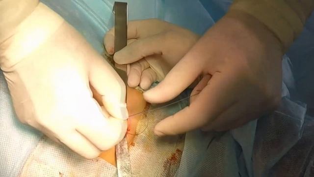 Паховая грыжа справа смотреть онлайн