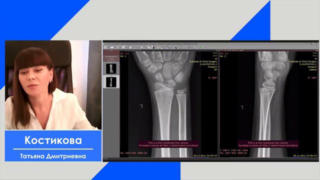 переломы детские особенности