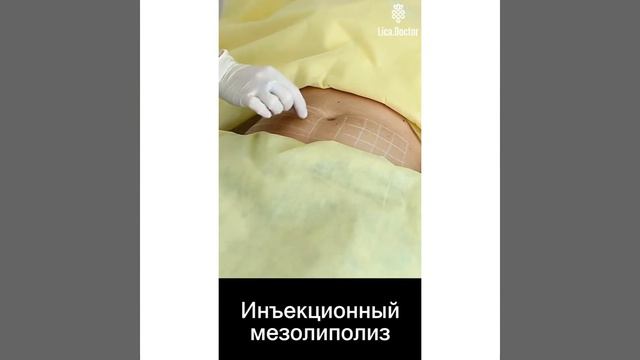 Lipolesse -инъекционный липолиз