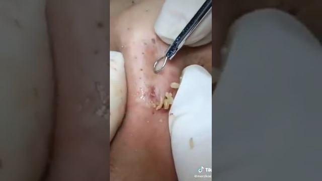 МНОГО ЧЁРНЫХ ТОЧЕК. ПРЫЩИ АКНЕ ГНОЙ смотреть онлайн