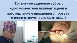Тотальное удаление зубов с одномоментной имплантацией и изготовлением временного протеза на 4-х импл