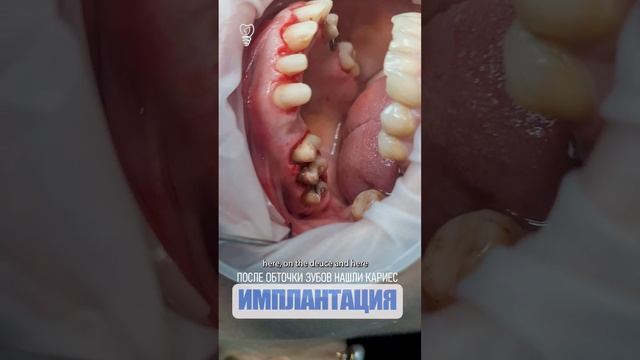 После обточки зубов нашли кариес. After turning the teeth, caries was found.