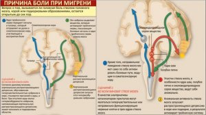 ГОЛОВНАЯ БОЛЬ. МИГРЕНЬ