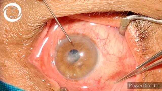 How to inject Intrastromal antifungals смотреть онлайн