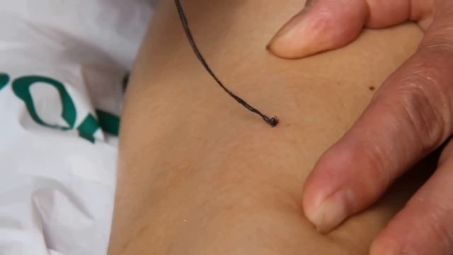 Как правильно вытаскивать клеща (полевые условия) смотреть онлайн