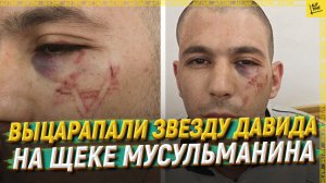 Выцарапали звезду Давида на щеке мусульманина