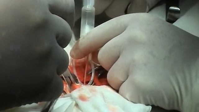 трансплантация Биостэм смотреть онлайн