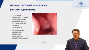 Острые заболевания глотки