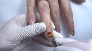 Онихолизис. ТАК ДЕЛАТЬ НЕЛЬЗЯ!!! Перекрываем больные ногти