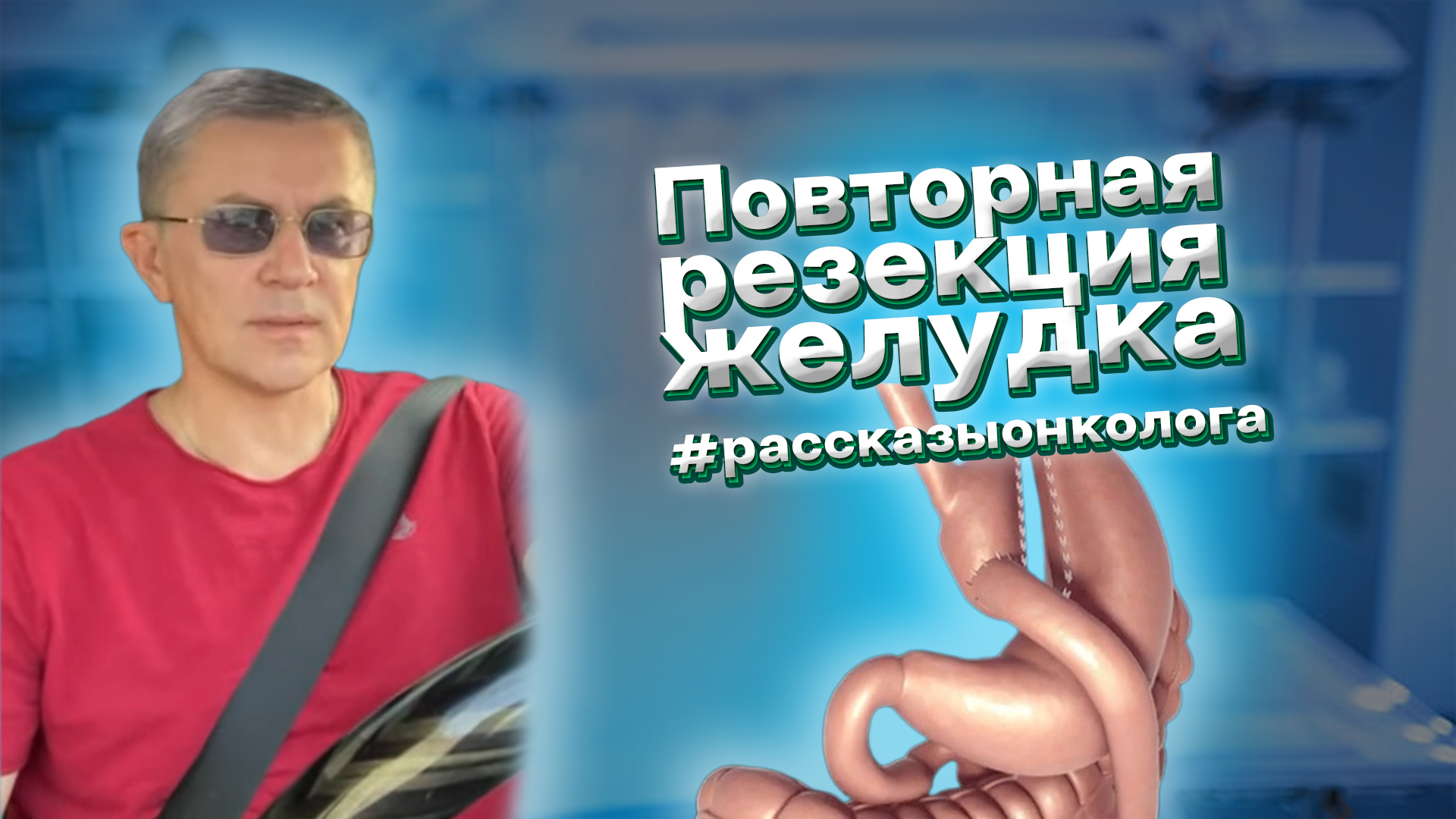 Повторная резекция желудка с реконструкцией по Ру