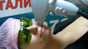 Лазерная эпиляция верхней губы - ЛазерОК -Киев