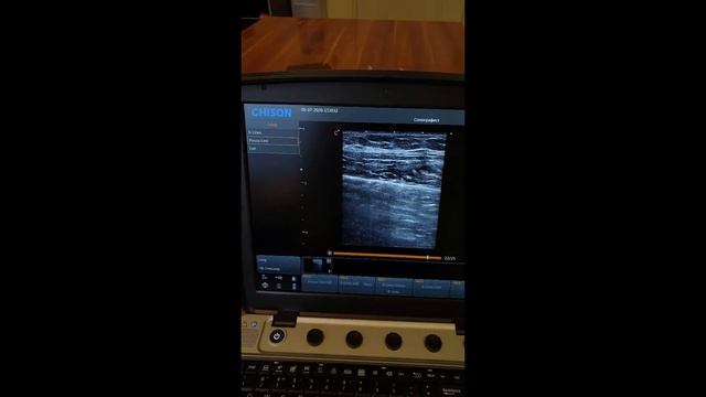 SonoPleura (Chison Sonotouch 80 Expert)