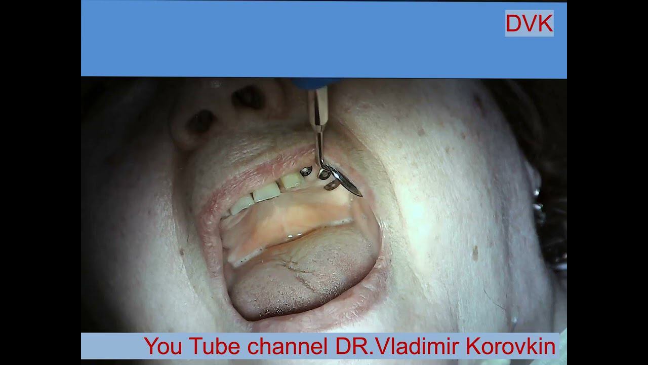 Infiltration Anesthesia for treatment 22 tooth.