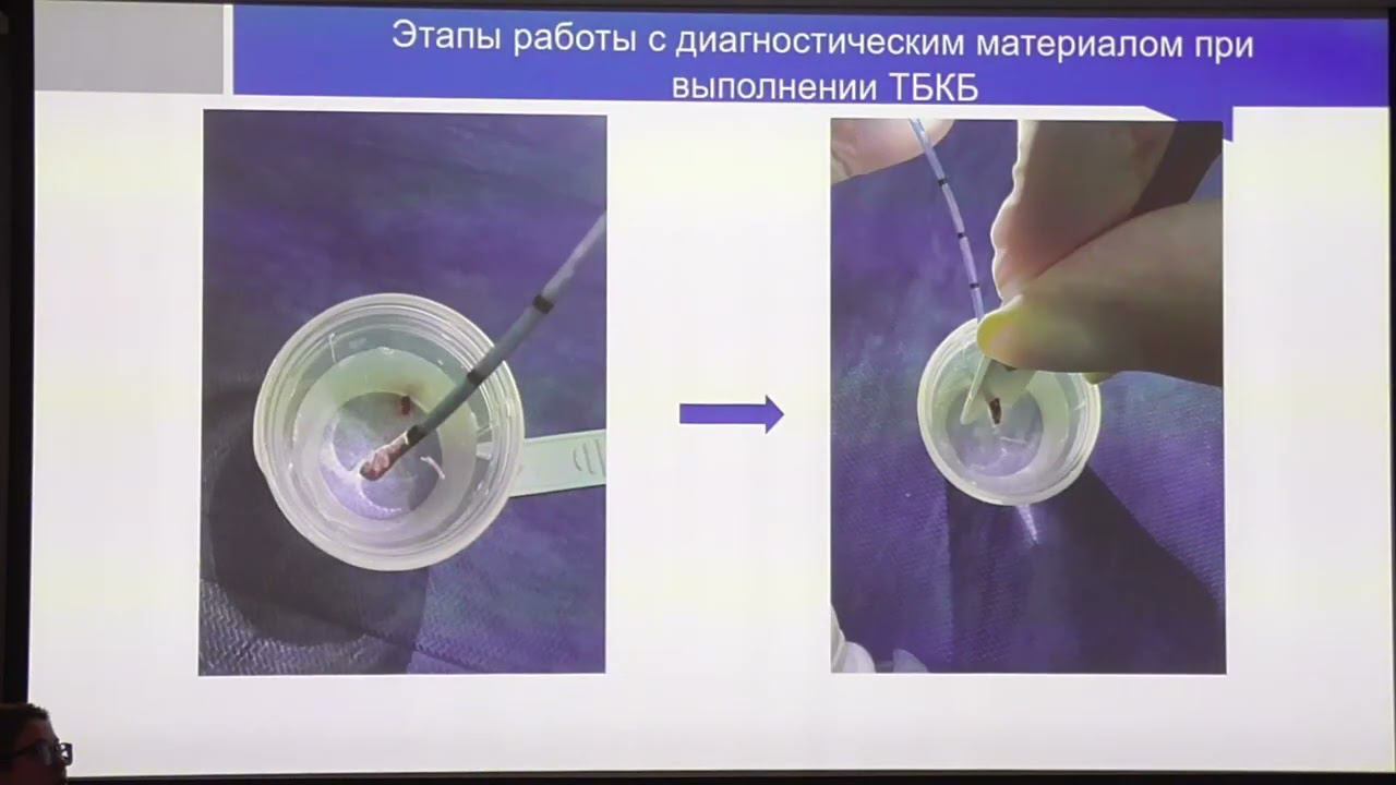 2024 03 28 Сестры07 Тытус АА Ассистирование в Бронхоскопии  Как правильно приготовить биоптаты