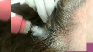 Дермапен в борьбе против выпадения волос