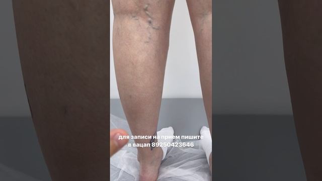 Сосудистая сетка. Варикоз. Как лечить варикоз? Флеболог Москва. Флеболог смотреть онлайн