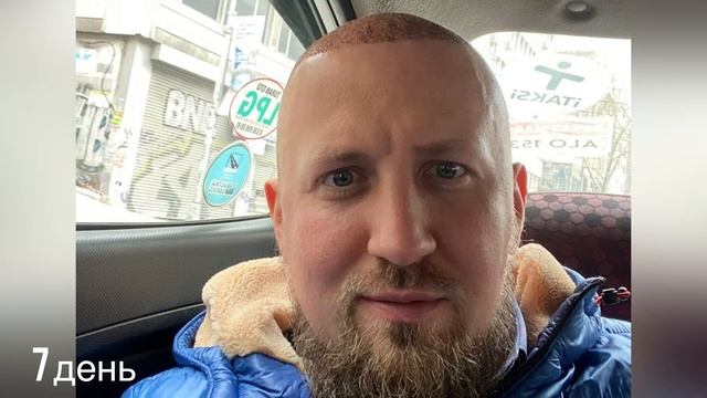 ПОЛУЧИЛСЯ ЛИ РЕЗУЛЬТАТ ПОСЛЕ ПЕРЕСАДКИ? ПЕРЕСАДКА ВОЛОС. 11 МЕСЯЦЕВ СПУСТЯ. смотреть онлайн