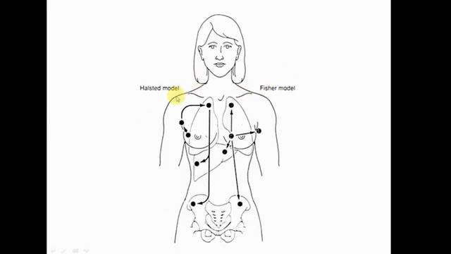 Prevention of Breast Cancer Related Lymphedema - Dr. Sheldon M. Feldman, MD, FACS смотреть онлайн