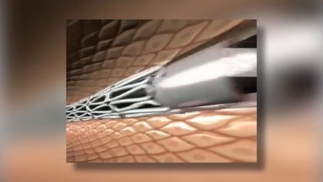 Факты о сердце. Ишемическая болезнь сердца смотреть онлайн