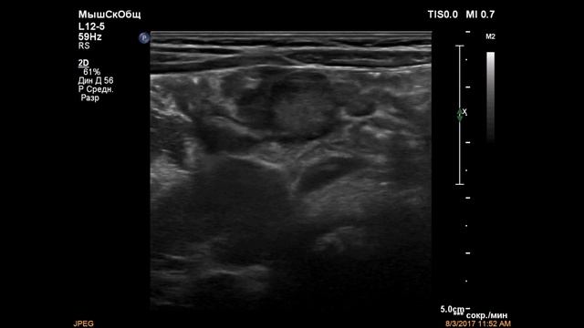 Мезаденит смотреть онлайн
