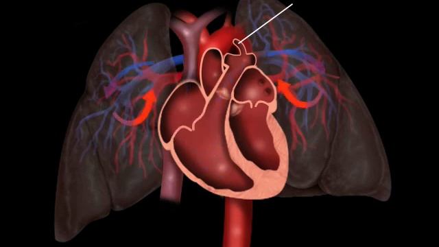 Patent Ductus Arteriosus смотреть онлайн