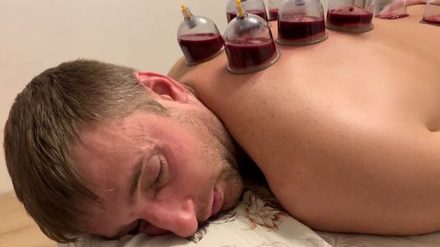 Капиллярное кровопускание. Хиджама