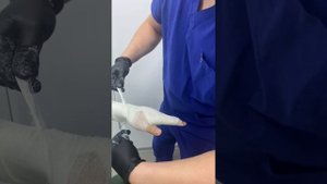 Перелом пястных кости руки