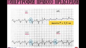 Расшифровка ЭКГ при гипертрофии предсердий